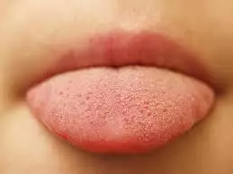 vapers-tongue